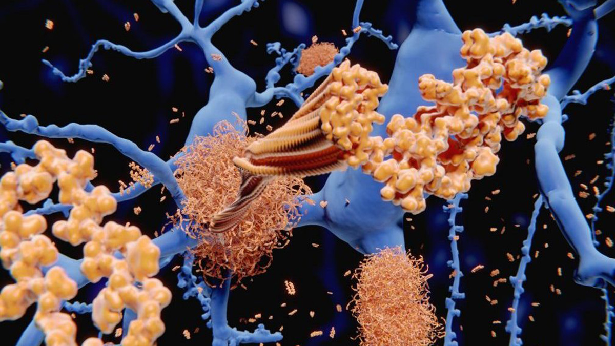 Enlarged rendering of Alzheimers amyloid