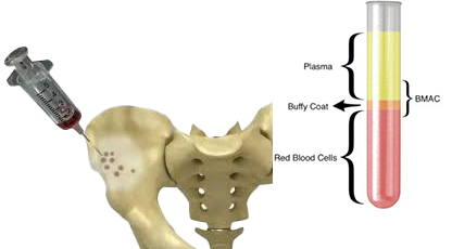 Diagram showing a syringe aspirating bone marrow from the hip bone next to a test tube separated into layers: plasma, buffy coat (BMAC), and red blood cells
